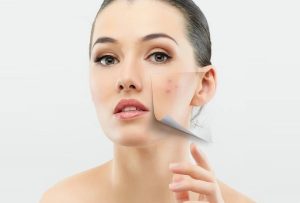 Mụn trứng cá có tự hết được không?