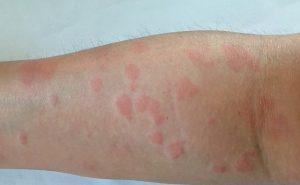 Phát ban là dấu hiệu đầu tiên nhận biết ghẻ